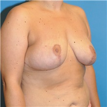 Breast Reduction After Photo by Joshua Cooper, MD; Seattle, WA - Case 34643