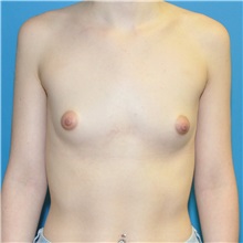 Breast Augmentation Before Photo by Joshua Cooper, MD; Seattle, WA - Case 36424