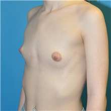 Breast Augmentation Before Photo by Joshua Cooper, MD; Seattle, WA - Case 36424