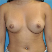 Breast Augmentation After Photo by Joshua Cooper, MD; Seattle, WA - Case 36426