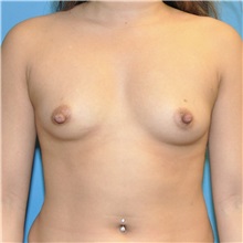Breast Augmentation Before Photo by Joshua Cooper, MD; Seattle, WA - Case 36426