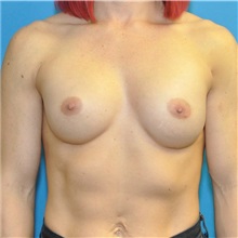 Breast Augmentation After Photo by Joshua Cooper, MD; Seattle, WA - Case 37705