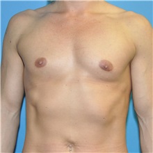 Breast Augmentation Before Photo by Joshua Cooper, MD; Seattle, WA - Case 37705