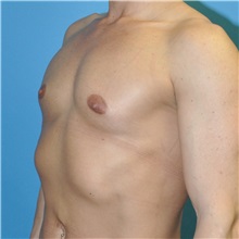 Breast Augmentation Before Photo by Joshua Cooper, MD; Seattle, WA - Case 37705