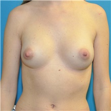 Breast Augmentation After Photo by Joshua Cooper, MD; Seattle, WA - Case 38669