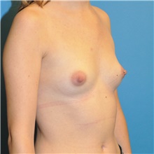 Breast Augmentation Before Photo by Joshua Cooper, MD; Seattle, WA - Case 38669