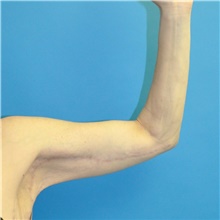 Arm Lift After Photo by Joshua Cooper, MD; Seattle, WA - Case 38714