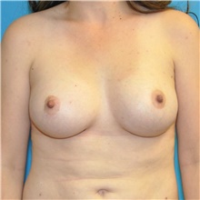Breast Augmentation After Photo by Joshua Cooper, MD; Seattle, WA - Case 40409