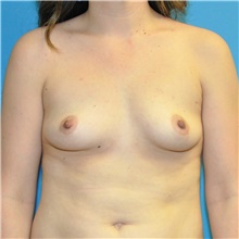 Breast Augmentation Before Photo by Joshua Cooper, MD; Seattle, WA - Case 40409