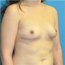 Breast Augmentation Before Photo by Joshua Cooper, MD; Seattle, WA - Case 40409