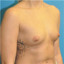 Breast Augmentation Before Photo by Joshua Cooper, MD; Seattle, WA - Case 40410