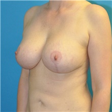 Breast Lift After Photo by Joshua Cooper, MD; Seattle, WA - Case 40481