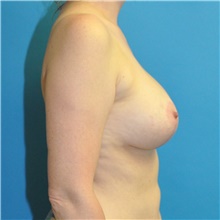 Breast Lift After Photo by Joshua Cooper, MD; Seattle, WA - Case 40481