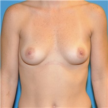 Breast Augmentation Before Photo by Joshua Cooper, MD; Seattle, WA - Case 40507