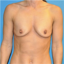 Breast Augmentation Before Photo by Joshua Cooper, MD; Seattle, WA - Case 40508