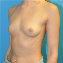Breast Augmentation Before Photo by Joshua Cooper, MD; Seattle, WA - Case 41620