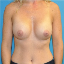 Breast Augmentation After Photo by Joshua Cooper, MD; Seattle, WA - Case 41621