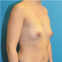 Breast Augmentation Before Photo by Joshua Cooper, MD; Seattle, WA - Case 41621
