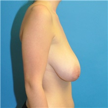 Breast Reduction Before Photo by Joshua Cooper, MD; Seattle, WA - Case 41759