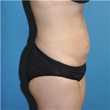 Tummy Tuck Before Photo by Joshua Cooper, MD; Seattle, WA - Case 41801