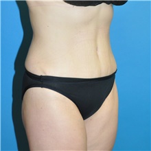 Tummy Tuck After Photo by Joshua Cooper, MD; Seattle, WA - Case 41801