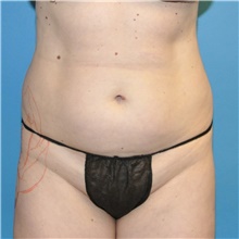 Liposuction Before Photo by Joshua Cooper, MD; Seattle, WA - Case 41805