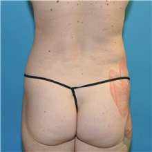 Liposuction After Photo by Joshua Cooper, MD; Seattle, WA - Case 41805