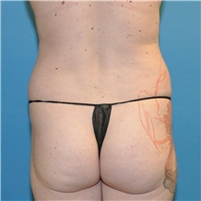 Liposuction Before Photo by Joshua Cooper, MD; Seattle, WA - Case 41805