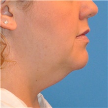 Liposuction Before Photo by Joshua Cooper, MD; Seattle, WA - Case 41806