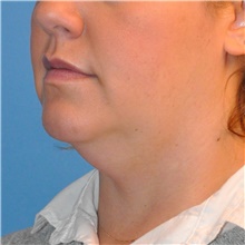 Liposuction Before Photo by Joshua Cooper, MD; Seattle, WA - Case 41806