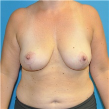 Breast Lift After Photo by Joshua Cooper, MD; Seattle, WA - Case 41855