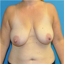 Breast Lift Before Photo by Joshua Cooper, MD; Seattle, WA - Case 41855
