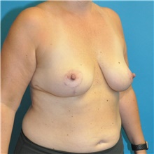 Breast Lift After Photo by Joshua Cooper, MD; Seattle, WA - Case 41855