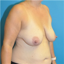 Breast Lift Before Photo by Joshua Cooper, MD; Seattle, WA - Case 41855