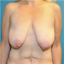 Breast Lift Before Photo by Joshua Cooper, MD; Seattle, WA - Case 41858