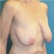 Breast Lift Before Photo by Joshua Cooper, MD; Seattle, WA - Case 41858