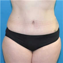 Tummy Tuck After Photo by Joshua Cooper, MD; Seattle, WA - Case 41861