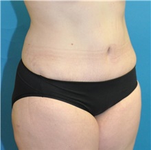 Tummy Tuck After Photo by Joshua Cooper, MD; Seattle, WA - Case 41861