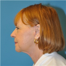 Neck Lift After Photo by Joshua Cooper, MD; Seattle, WA - Case 41862