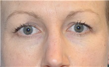 Eyelid Surgery Before Photo by Joshua Cooper, MD; Seattle, WA - Case 41867
