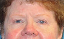 Eyelid Surgery After Photo by Joshua Cooper, MD; Seattle, WA - Case 41869