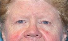 Eyelid Surgery Before Photo by Joshua Cooper, MD; Seattle, WA - Case 41869