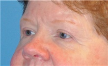 Eyelid Surgery After Photo by Joshua Cooper, MD; Seattle, WA - Case 41869