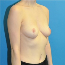 Breast Reduction After Photo by Joshua Cooper, MD; Seattle, WA - Case 42027