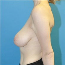 Breast Reduction Before Photo by Joshua Cooper, MD; Seattle, WA - Case 42027