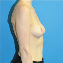 Breast Reduction After Photo by Joshua Cooper, MD; Seattle, WA - Case 42027