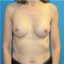 Breast Augmentation After Photo by Joshua Cooper, MD; Seattle, WA - Case 42148