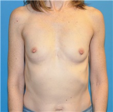 Breast Augmentation Before Photo by Joshua Cooper, MD; Seattle, WA - Case 42148