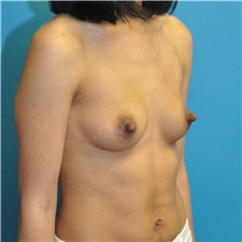 Breast Augmentation Before Photo by Joshua Cooper, MD; Seattle, WA - Case 42156