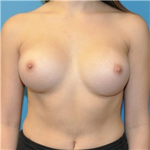Breast Augmentation After Photo by Joshua Cooper, MD; Seattle, WA - Case 42603